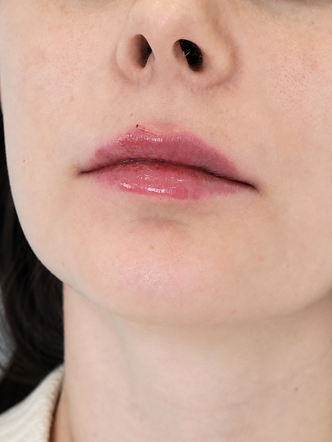 Lips after treatment, example 1
