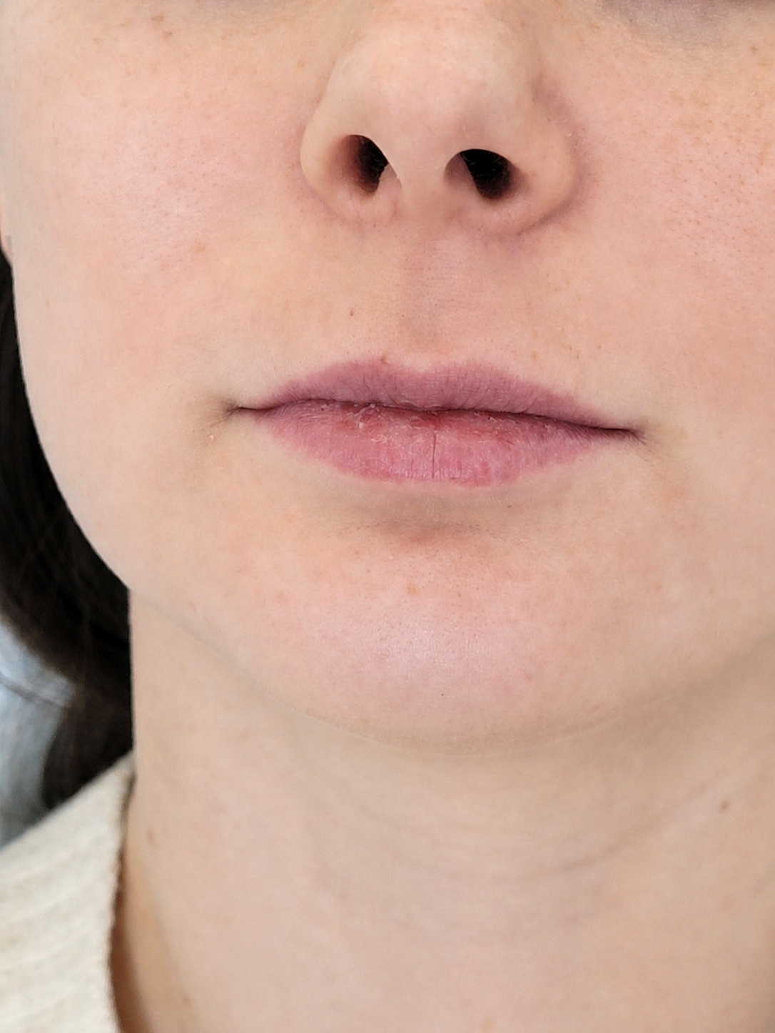 Lips before treatment, example 1
