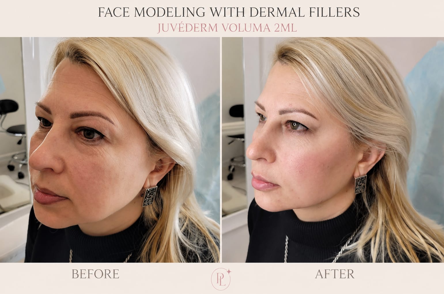 Facial Modeling with Dermal Fillers, before on the left and after on the right