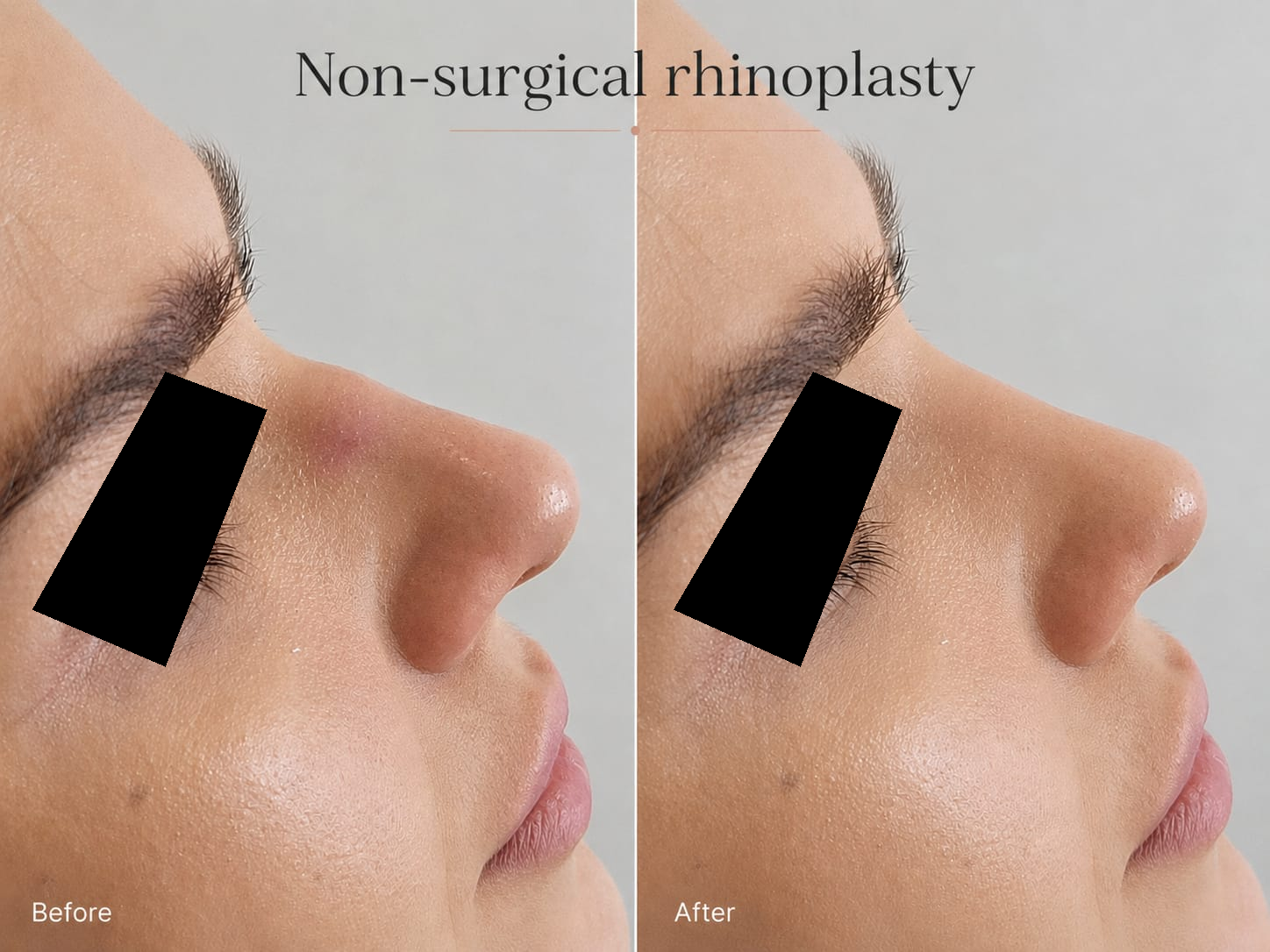 Nonsurgical Rhinoplasty, before on the left and after on the right