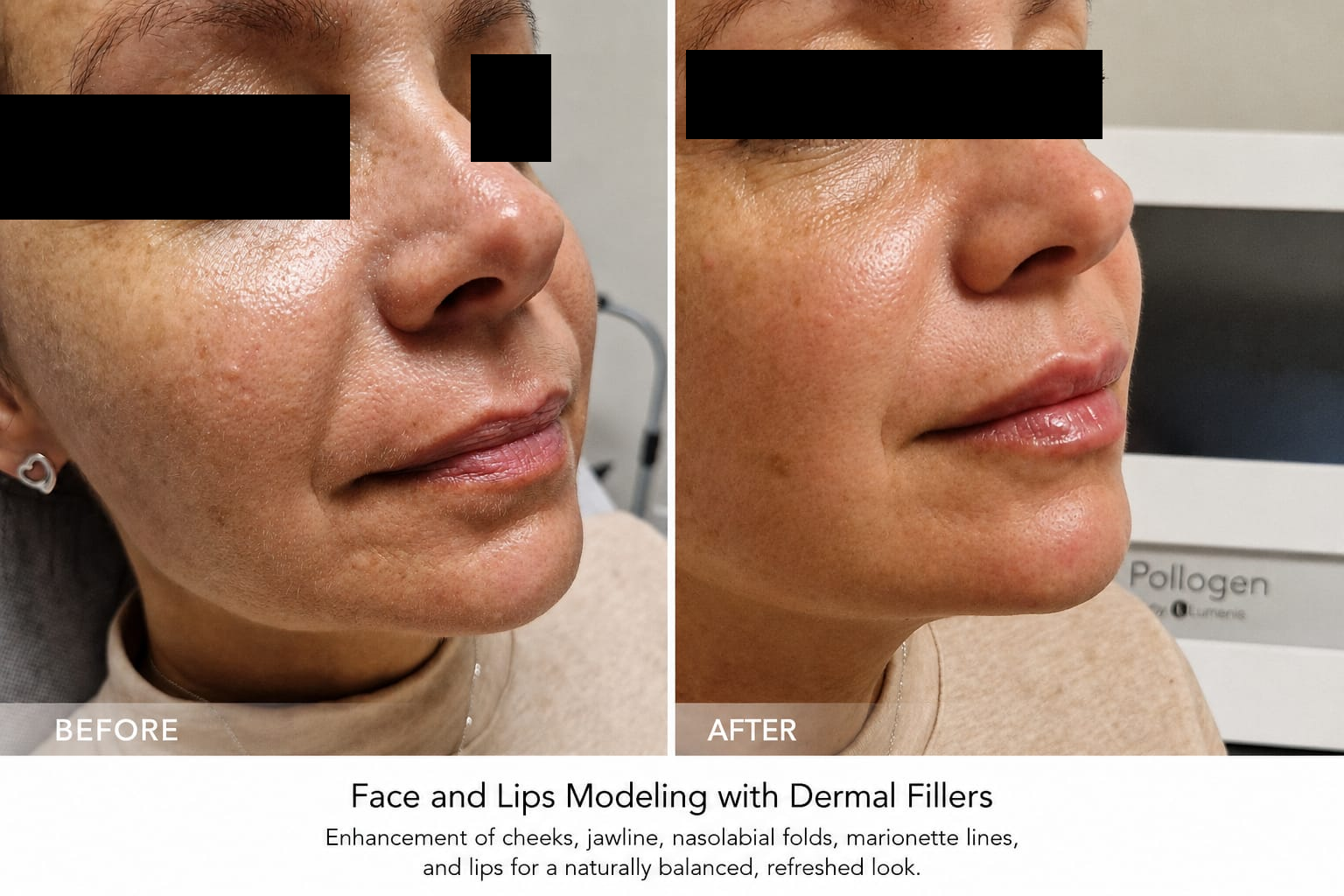 Face & Lip Modeling with Dermal Fillers, before on the left and after on the right