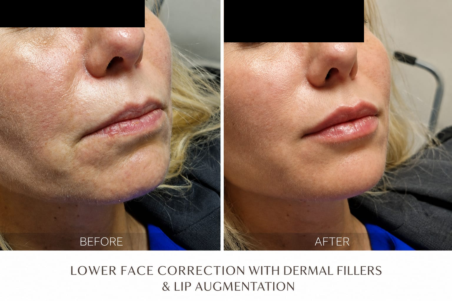 Lower Face Correction & Lip Augmentation, before on the left and after on the right