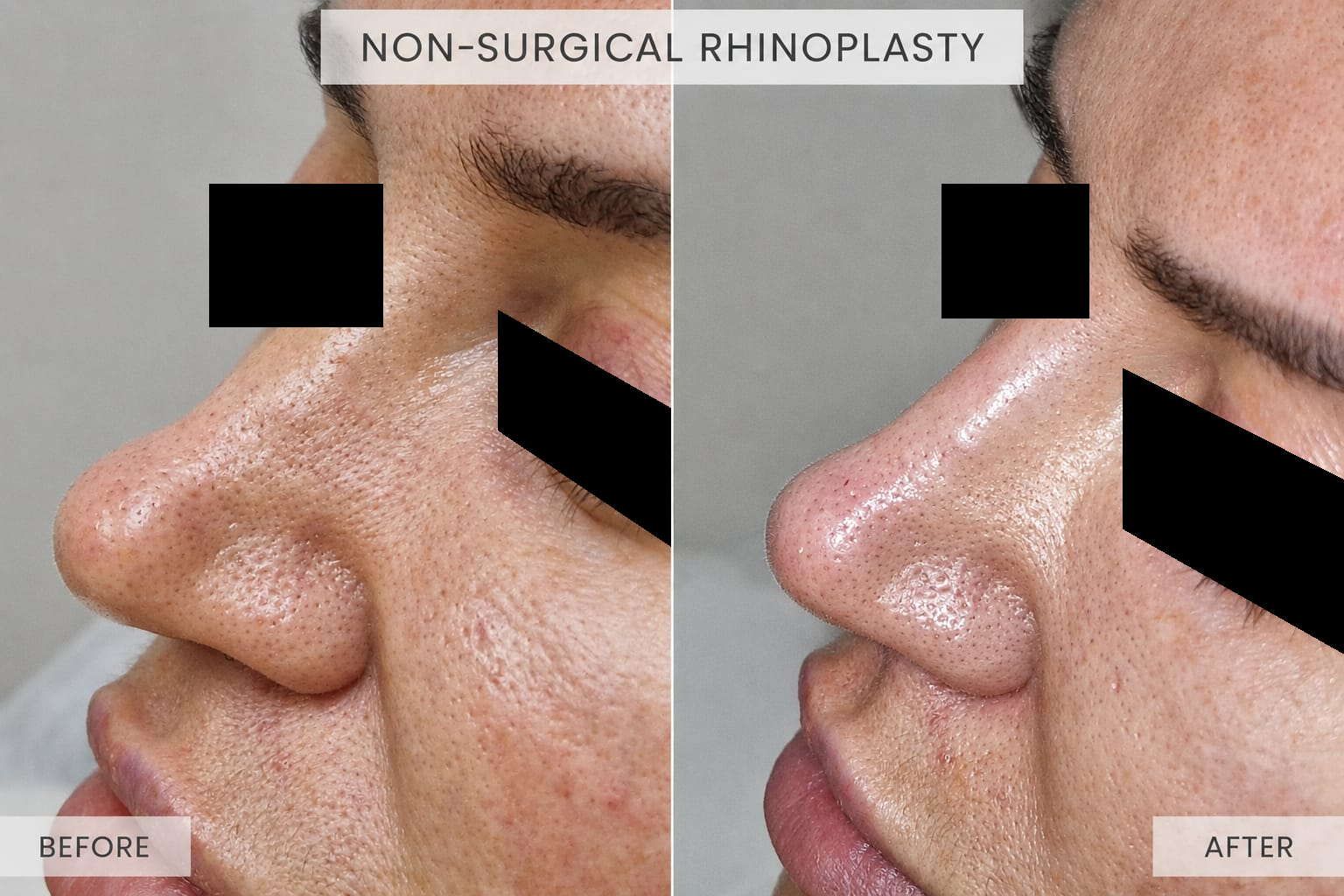 Nonsurgical Rhinoplasty, before on the left and after on the right