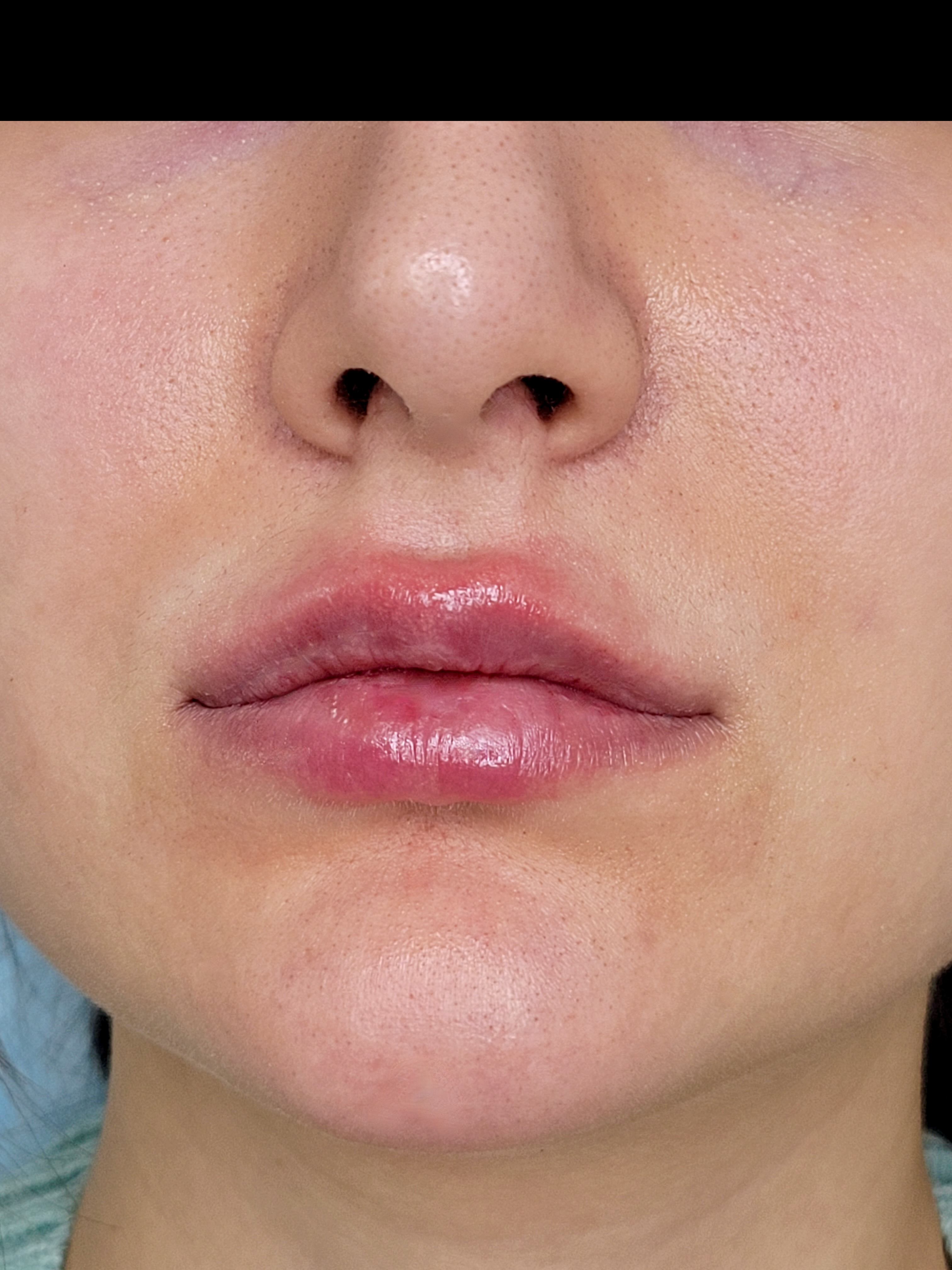 Lips after treatment, example 2