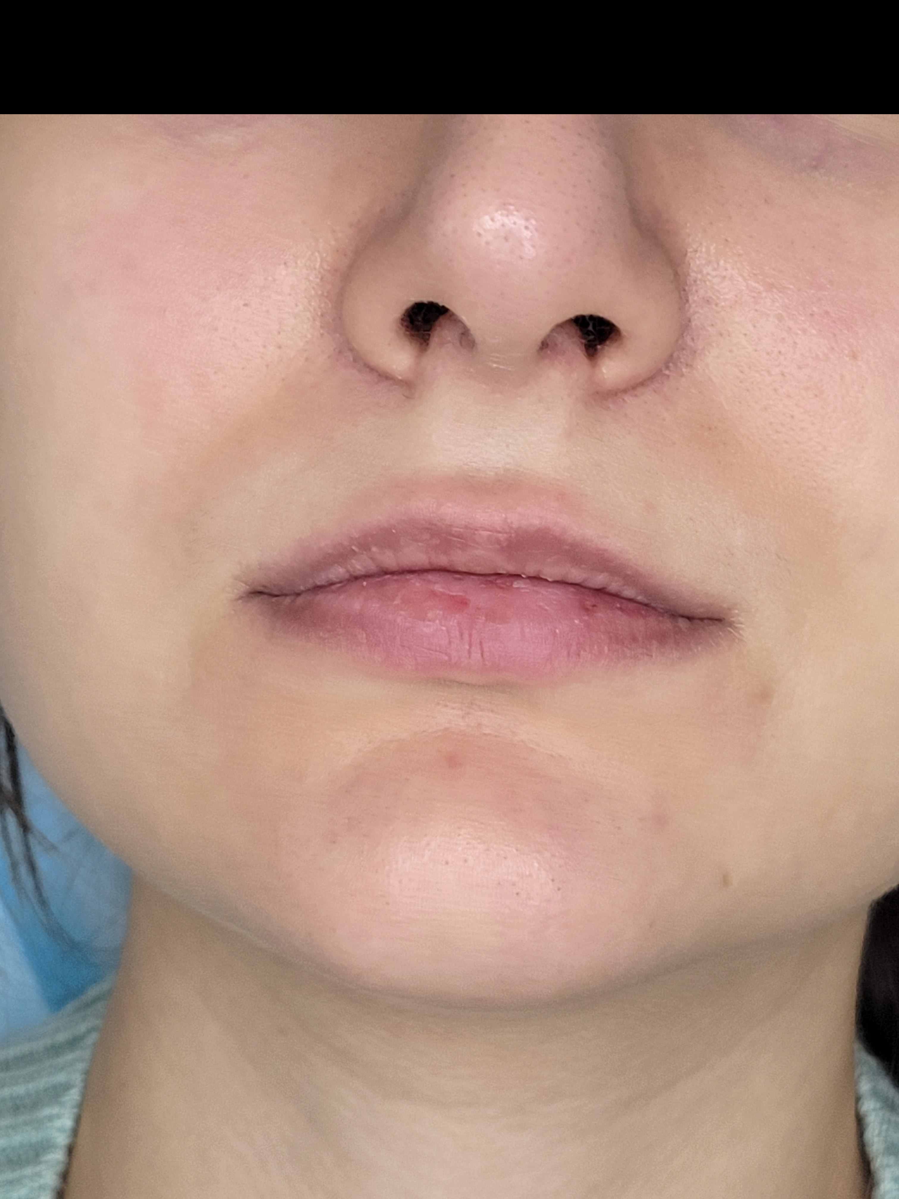 Lips before treatment, example 2